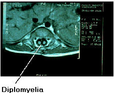 MRI Diplomyelia